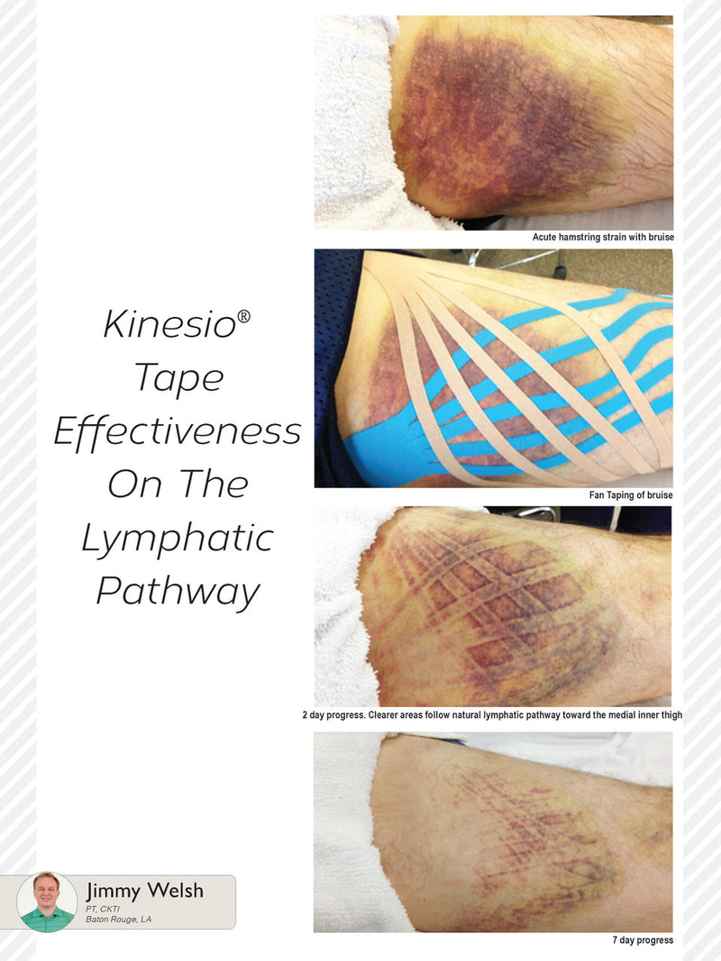 Kinesio® Classic Fan Cut Tape